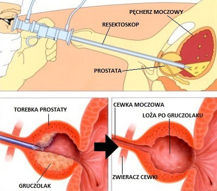 jakie pieluchomajtki kupić dla 8 letniego dziecka